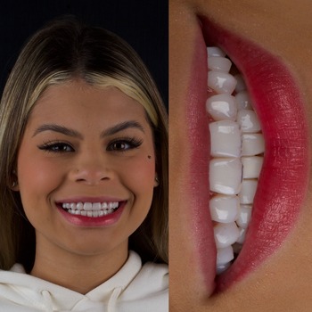 Lente de Contato Dental Resina