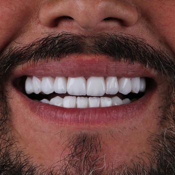 Especialistas em Lente de Contato Dental