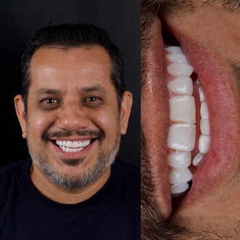 Lente de Resina Dental